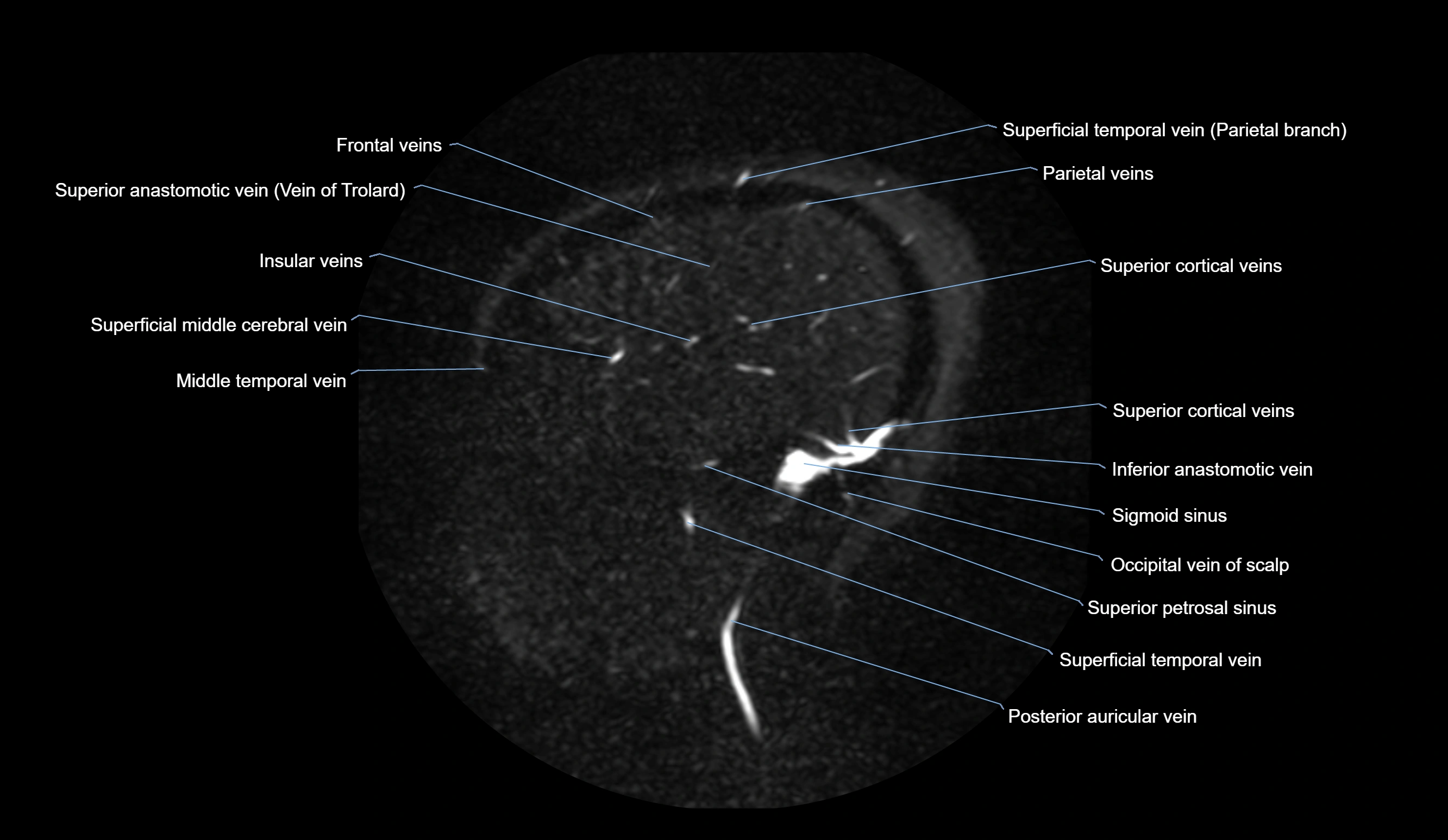 MRV brain sagittal anatomy 3T MRI images -img-01015-00017.webp